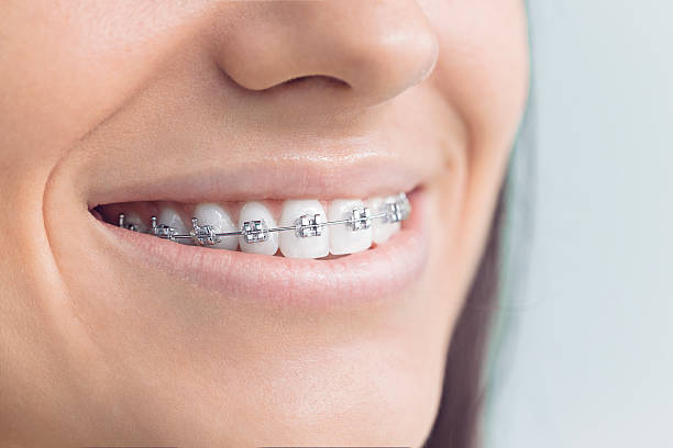 Dental Bonding in Garyville, LA